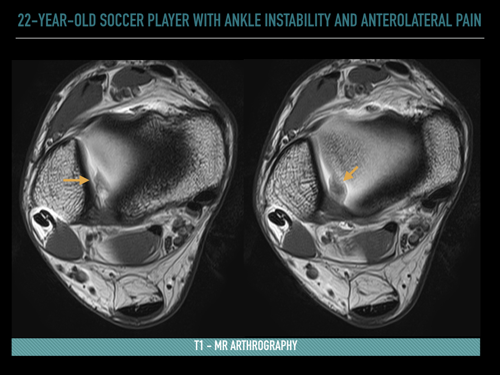 Figure 2 for case Syndesmotic ankle impingement